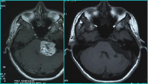 Neurinoma dell'ottavo nervo cranico