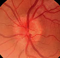 Neurite ottica