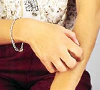 Orticaria