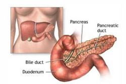 Pancreatite acuta