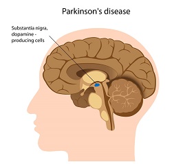 parkinson_morbo_di
