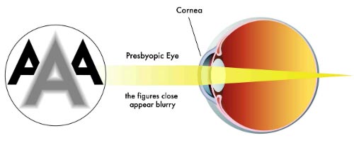 Presbiopia
