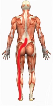 Sciatalgia (sciatica)