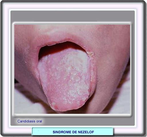 Sindrome di Nezelof