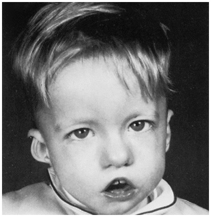 Sindrome di George