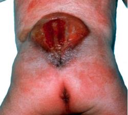 Spina bifida