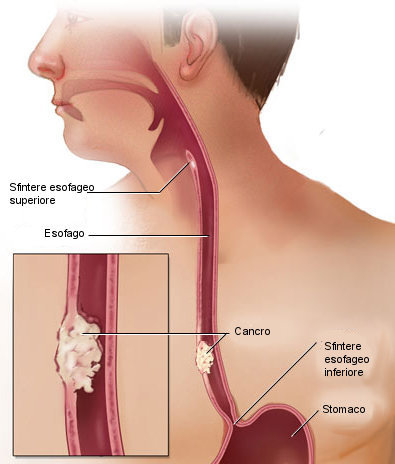 Tumore all'esofago