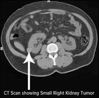 Tumore del rene