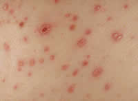 Varicella