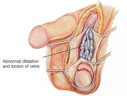 Varicocele