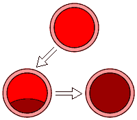 Aterosclerosi e arteriosclerosi