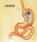 Ulcera gastroduodenale