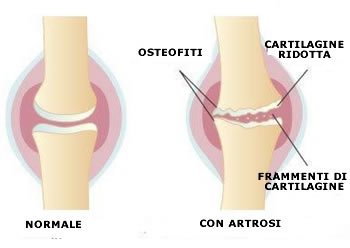 Artrosi ginocchio