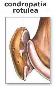 Contropatia rotulea