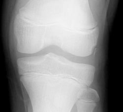 Fratture del ginocchio