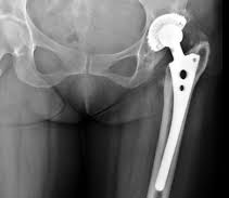 Intervento protesi d'anca