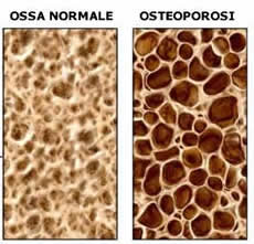 Osteoporosi