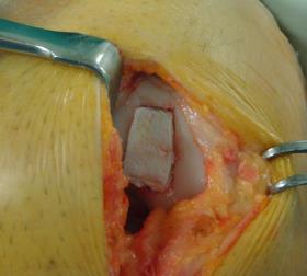 Trapianto di cartilagine articolare del ginocchio