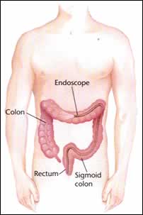 Tumore al colon-retto