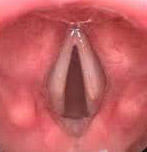 Tumore della laringe e della faringe