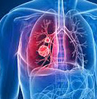 Tumore del polmone