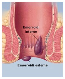 Dieta emorroidi